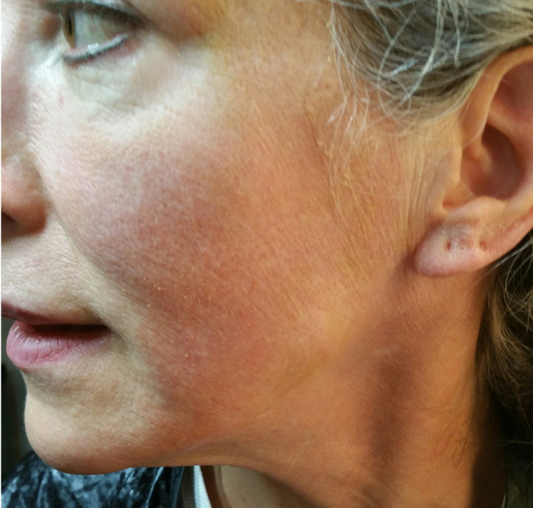 Collagen Induction Therapy or Skin Needling or Microneedling for Scars